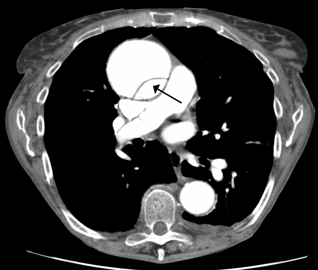 Axial contrast CT with an arrow on a curved intimal flap inside a dilated ascending aorta
