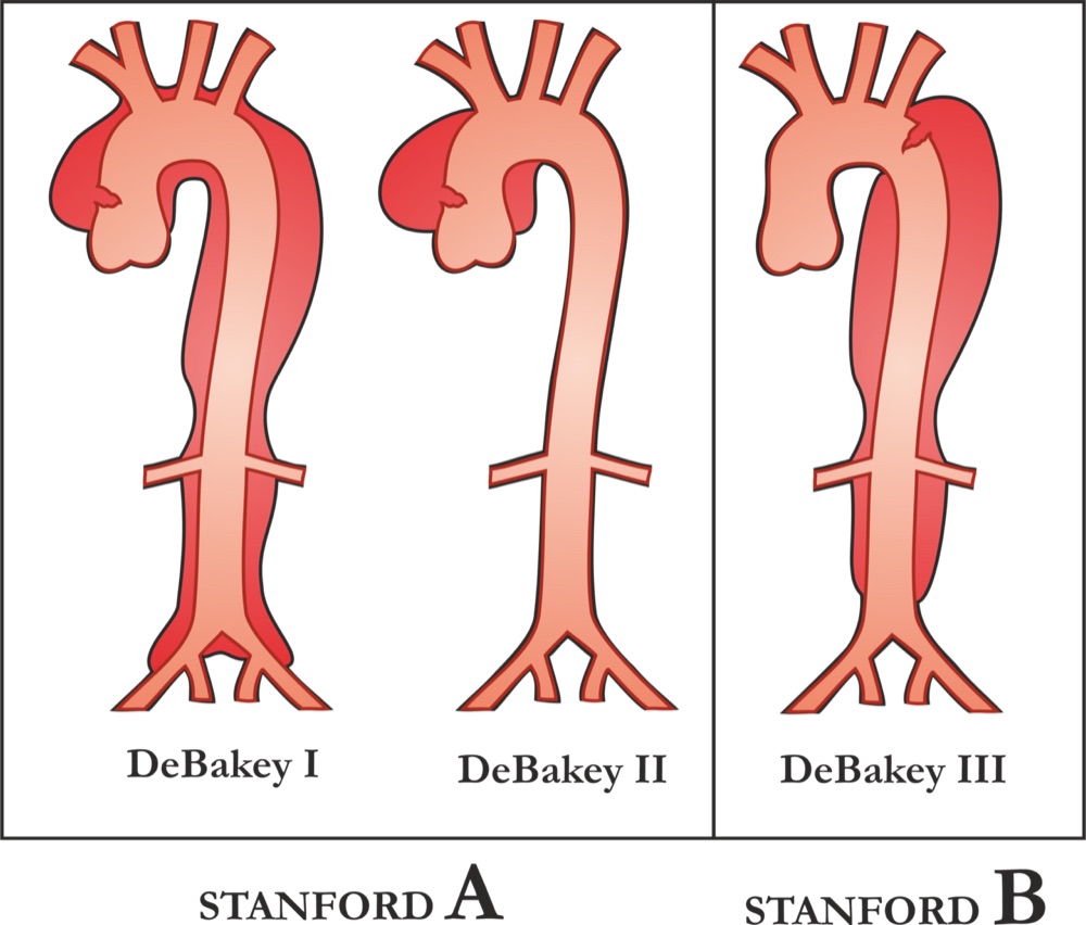 Diagram of three aortas: DeBakey I and II grouped as Stanford A involving the ascending aorta, DeBakey III as Stanford B starting beyond the left subclavian artery