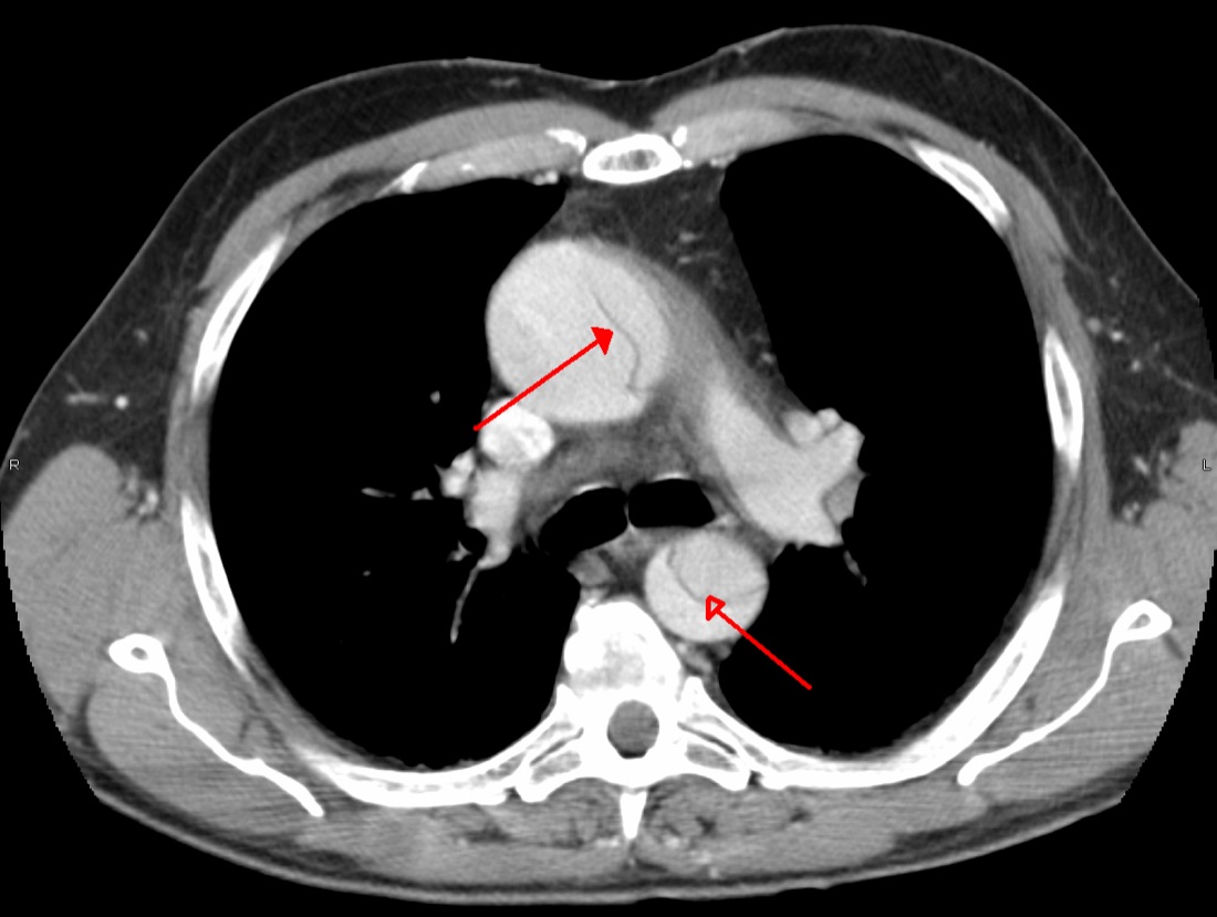 Axial contrast CT of the chest with arrows on dissection flaps in the ascending and descending aorta