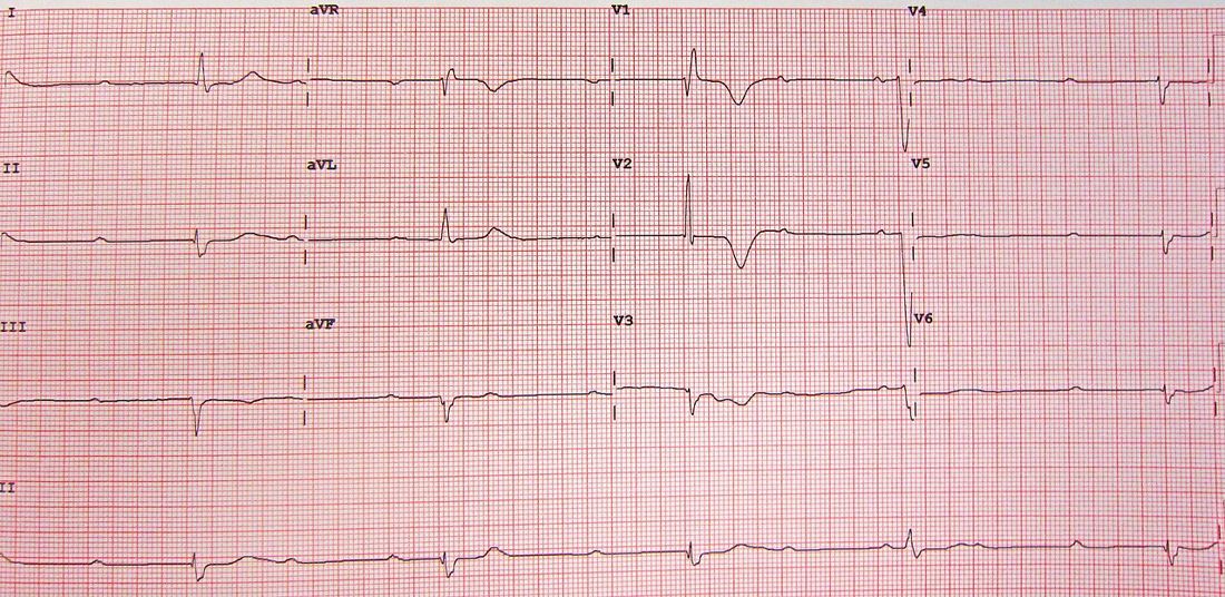 12-lead ECG with a lead II rhythm strip showing regular P waves dissociated from a very slow ventricular rhythm