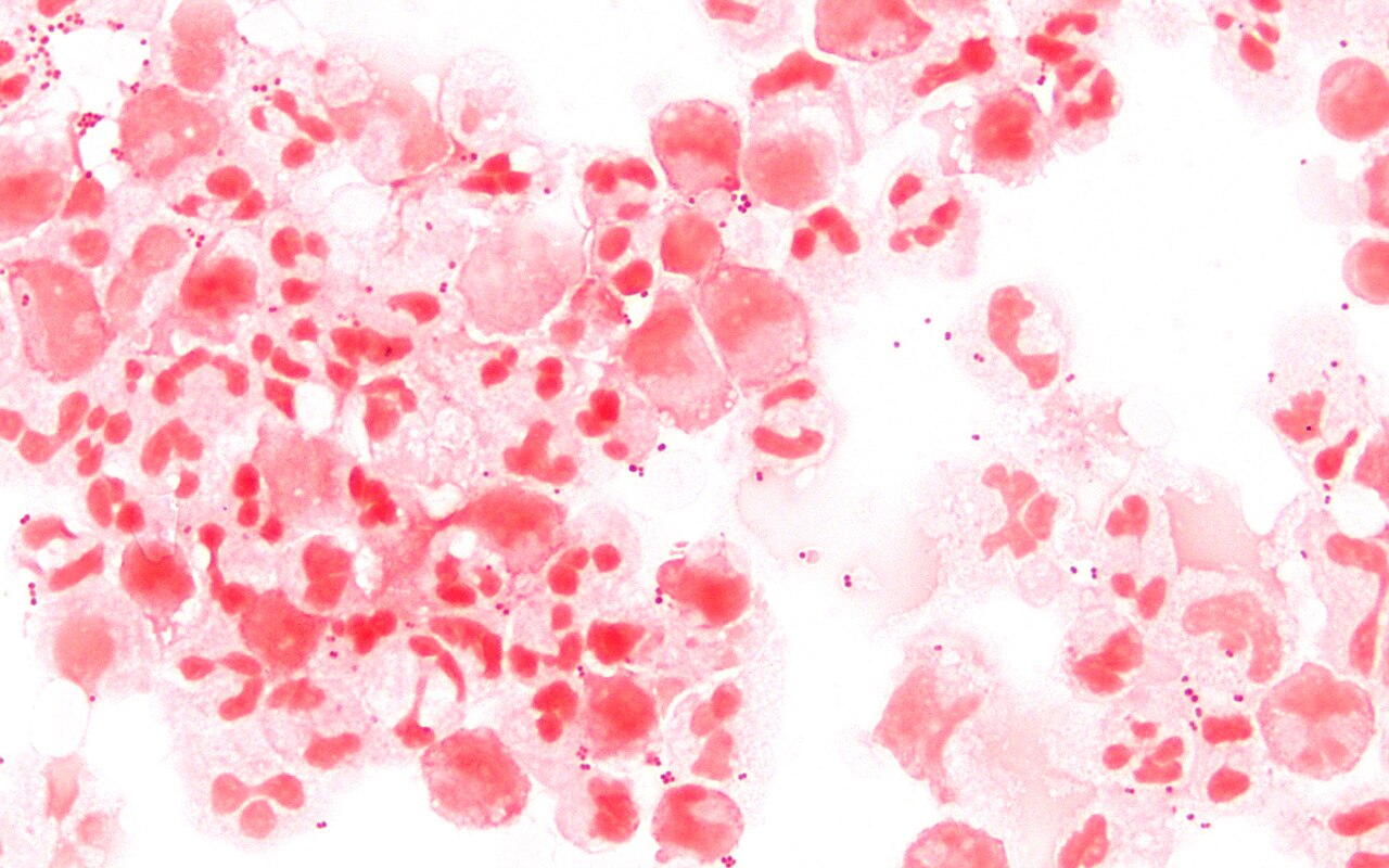 Microscope image of a Gram-stained spinal fluid sample showing many pink neutrophils and tiny paired round bacteria scattered between them