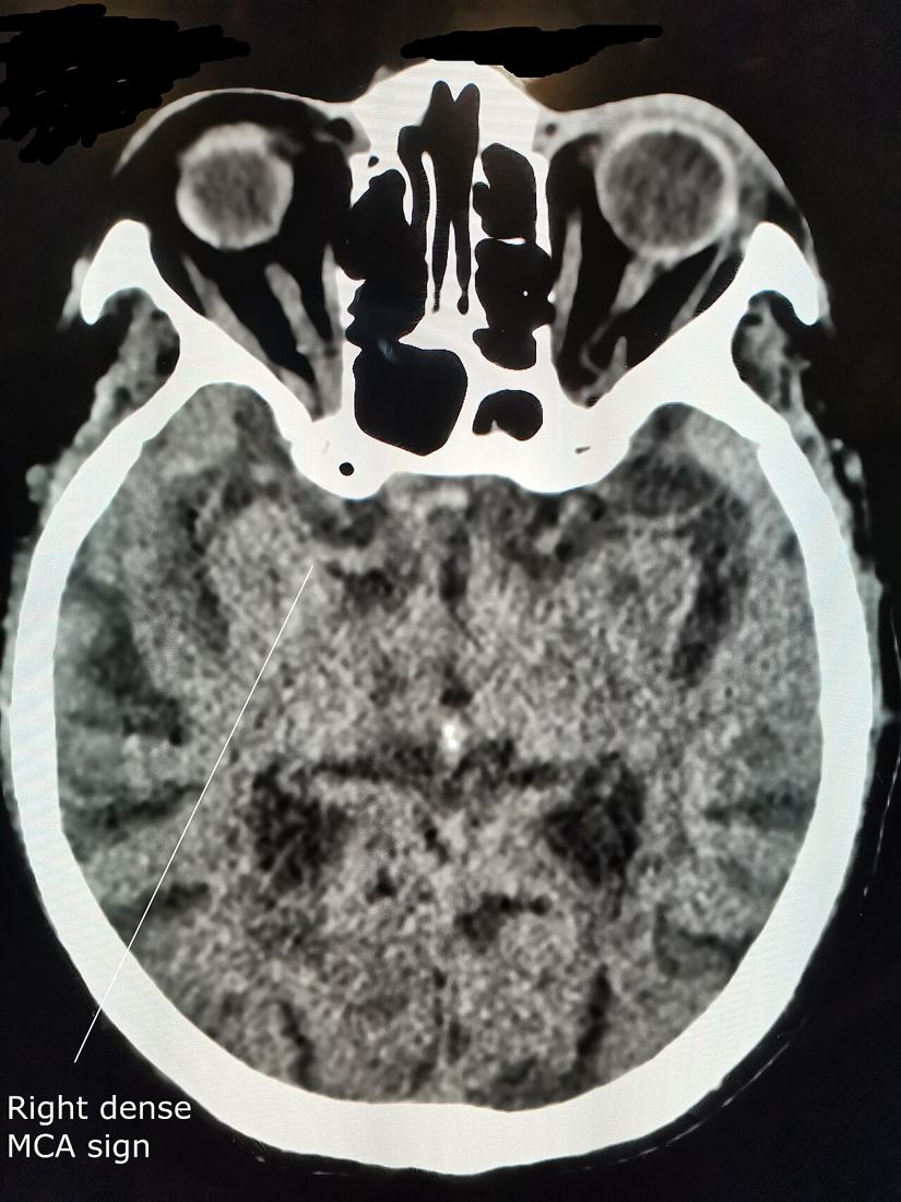 Axial non-contrast CT of the brain with a label pointing to a hyperdense right middle cerebral artery