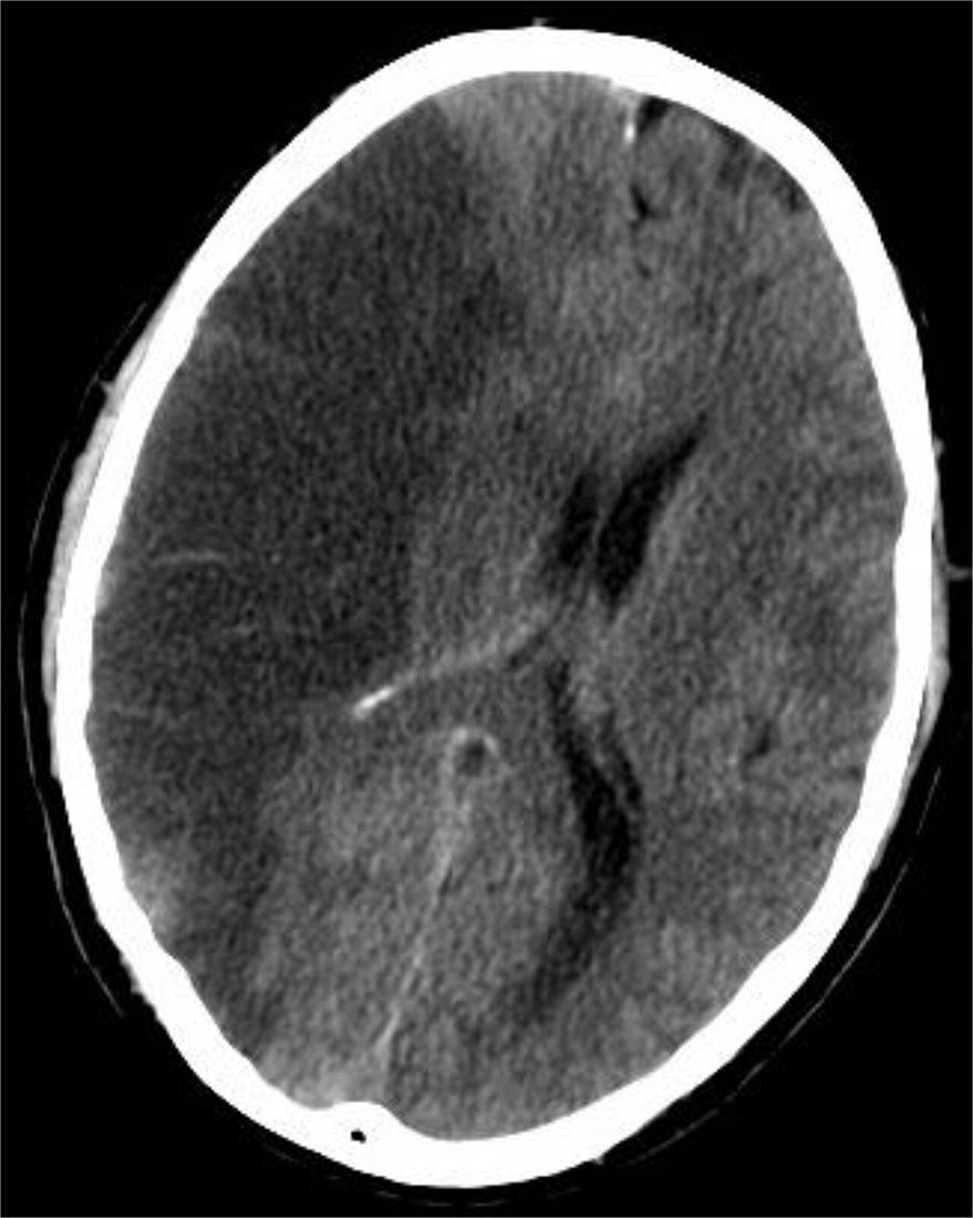Axial non-contrast CT of the brain showing a large hypodense infarct in the right middle cerebral artery territory with mass effect on the right lateral ventricle