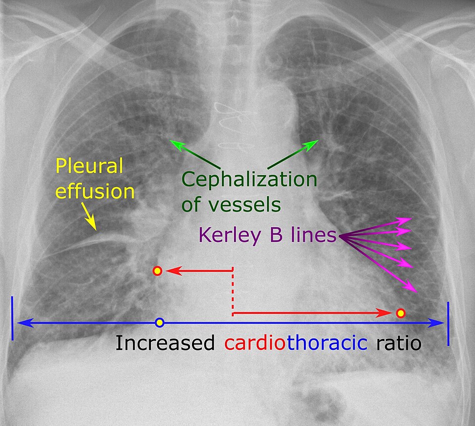 Annotated frontal chest radiograph showing Kerley B lines, a right pleural effusion, cephalization of pulmonary vessels and an increased cardiothoracic ratio