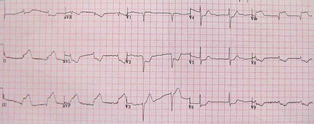 12-lead ECG with ST elevation in leads II, III and aVF, reciprocal ST depression in I and aVL, and additional V4R, V8 and V9 leads