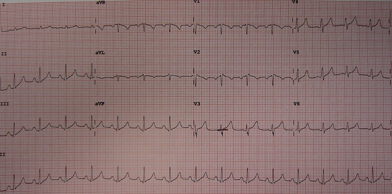 12-lead ECG at potassium 7.6 with tall narrow T waves in the inferior and precordial leads