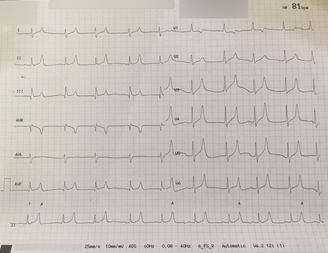 12-lead ECG at potassium 8.2 in a patient with kidney disease, showing peaked T waves across V2 to V6