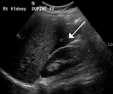 Bedside ultrasound of the right upper quadrant showing an anechoic stripe of free fluid between the liver and the right kidney, marked with an arrow
