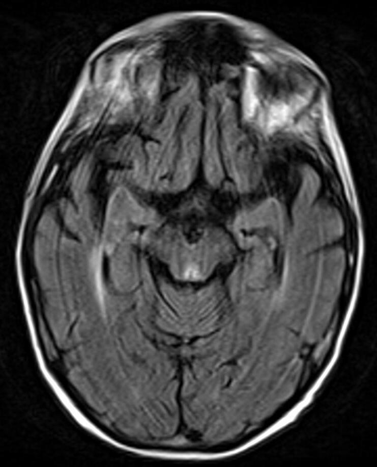 Axial FLAIR brain MRI with bright signal in the periaqueductal gray matter of the midbrain