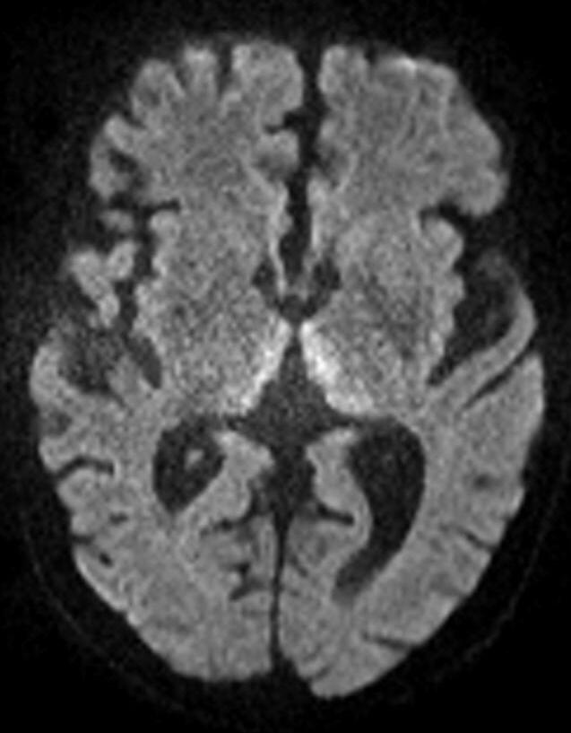 Axial diffusion-weighted brain MRI with symmetric bright signal in the medial thalami on both sides