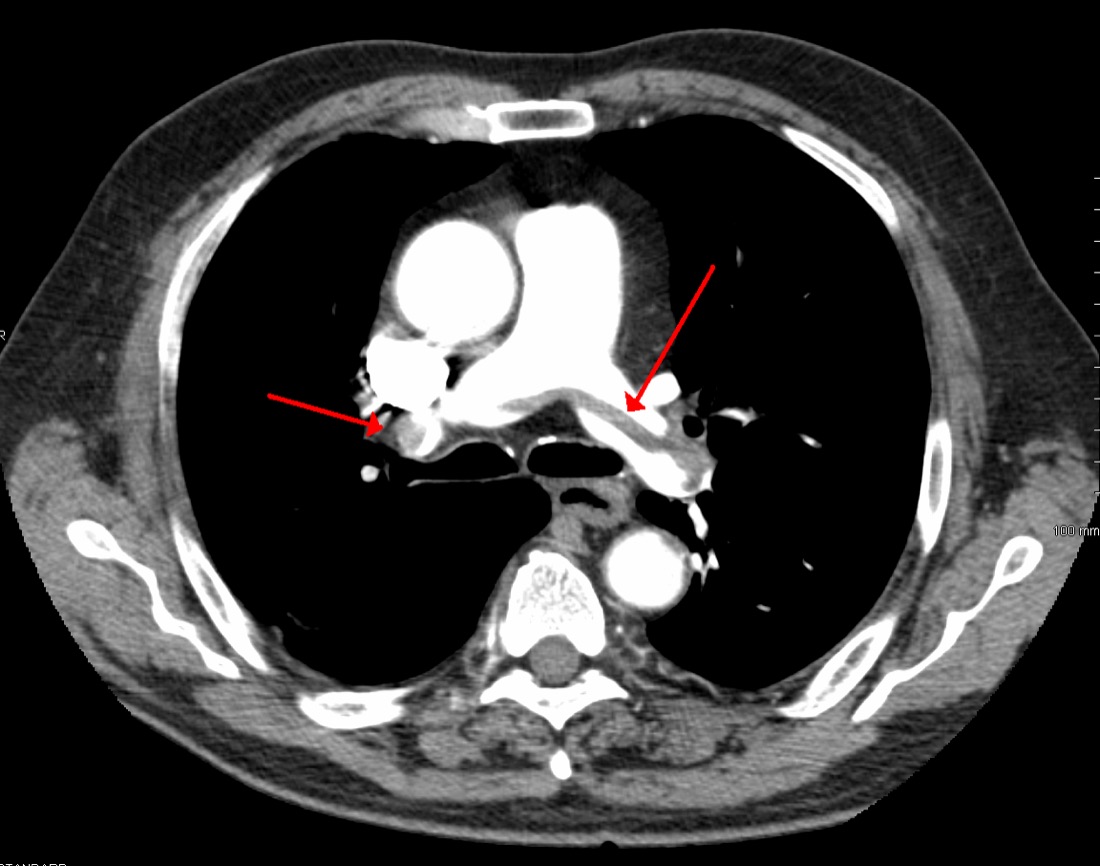 Axial CT pulmonary angiogram with red arrows on clot in both main pulmonary arteries at the bifurcation