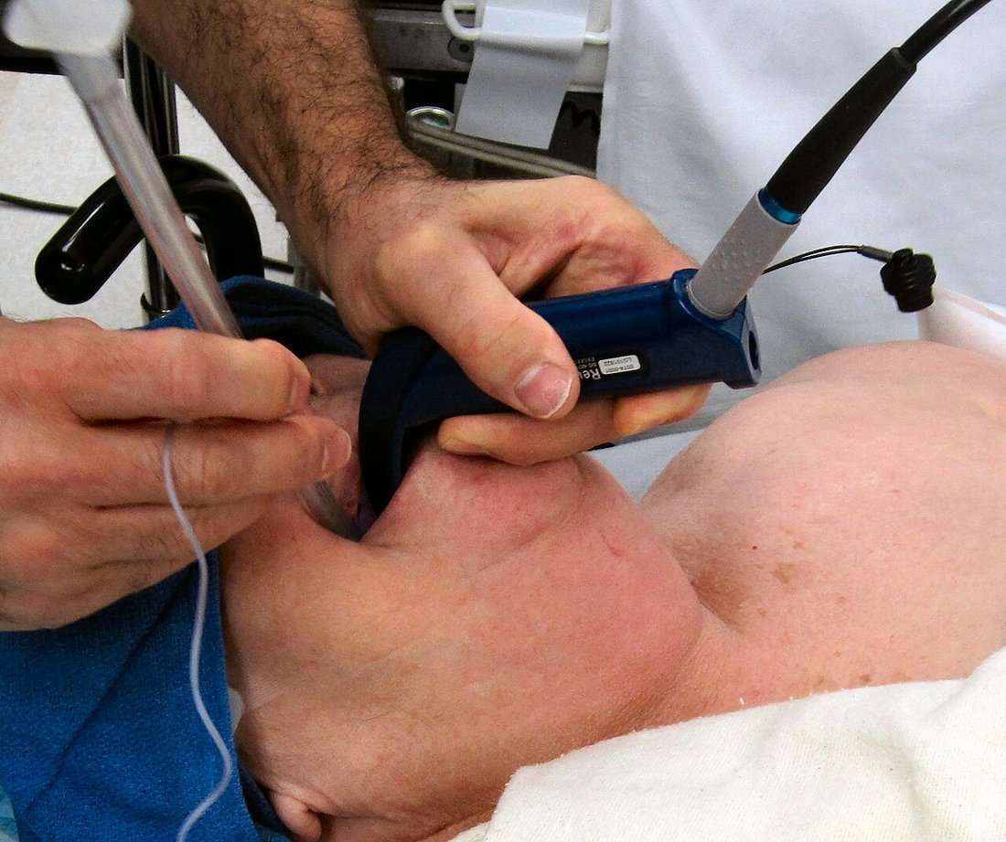 Clinician holding a blue GlideScope video laryngoscope in a patient's mouth while an assistant passes an endotracheal tube with stylet