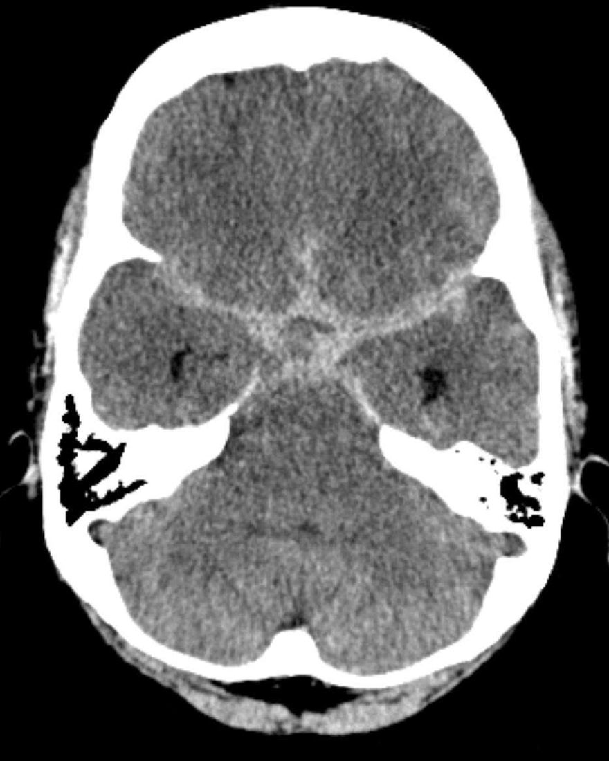 Axial noncontrast head CT with bright blood filling the basal cisterns in a star shape, extending into both sylvian fissures and the interhemispheric fissure