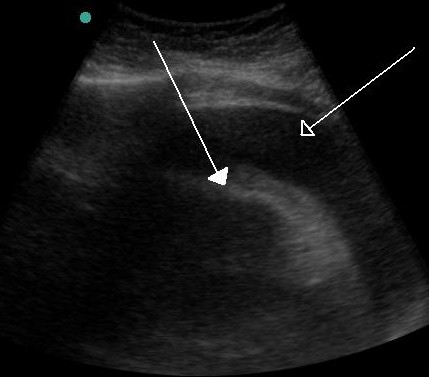 Cardiac ultrasound image of a very large hemorrhagic pericardial effusion, with two arrows