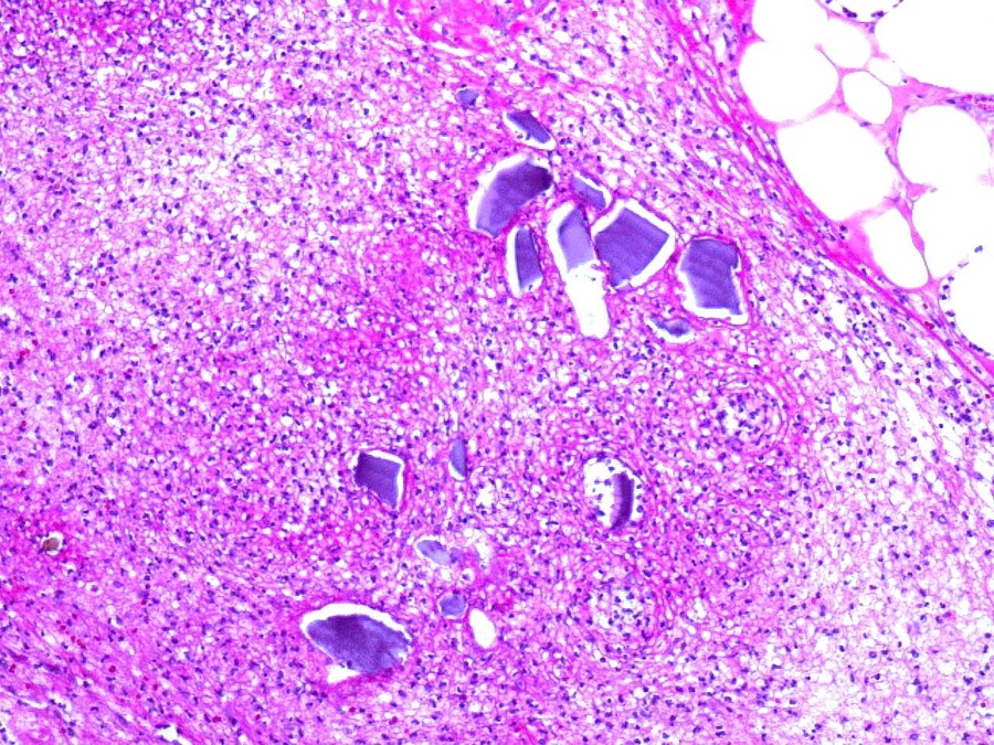 Histology slide showing angular purple Kayexalate crystals within inflammatory exudate next to a perforated colon