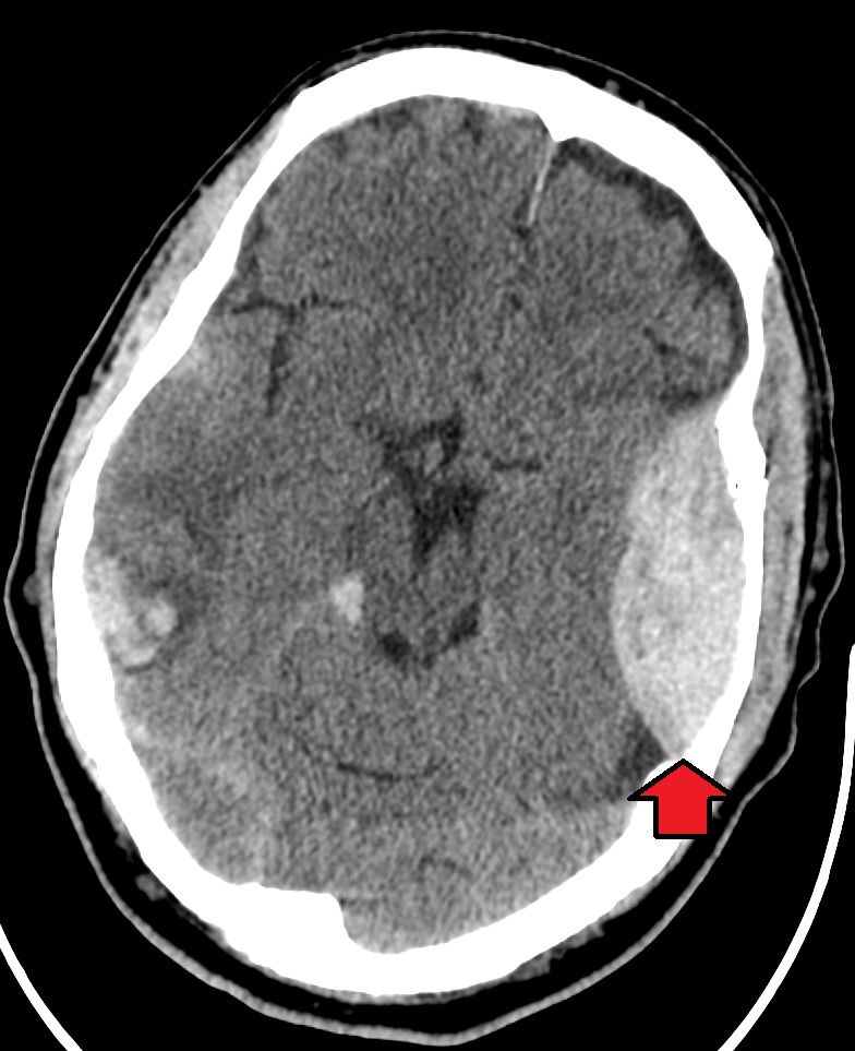 Axial non-contrast head CT with a lens-shaped hyperdense epidural hematoma along the left skull, marked with a red arrow, and a smaller area of blood on the right