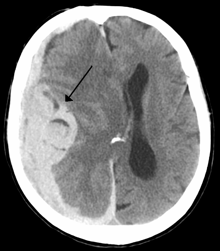 Axial non-contrast head CT with a large right-sided intracranial hemorrhage, an arrow marking the compressed right hemisphere, and the midline displaced to the left