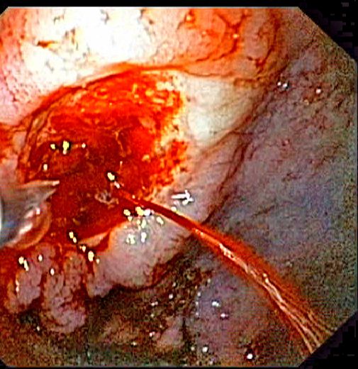 Endoscopic image of a gastric ulcer with a thin jet of bright red blood spurting from its base